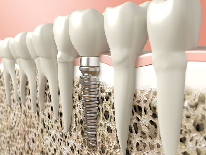 implants