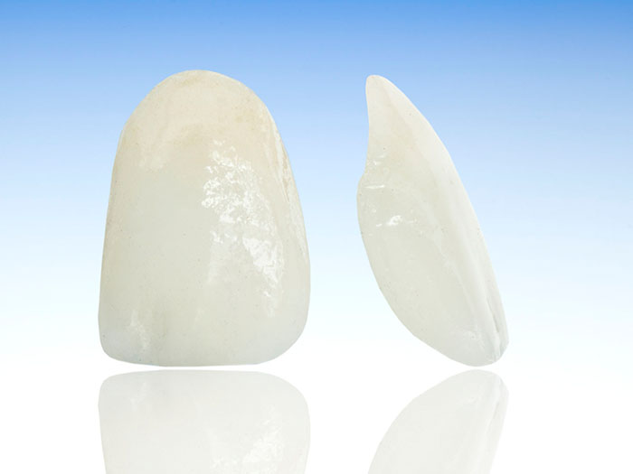 veneers